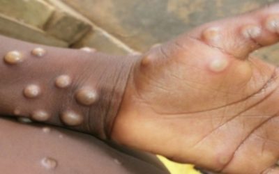 Viruela del mono: qué es, cómo se contagia y cuáles son los síntomas
