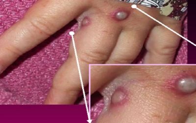 Viruela del mono: de qué trata esta enfermedad y qué riesgos entraña para la salud