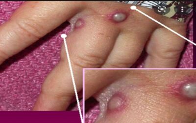 Rhode Island reporta tercer caso de viruela del mono.