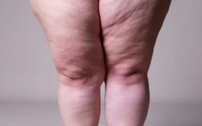 Estados Unidos, en el puesto 15 entre las naciones con más obesidad y sobrepeso del mundo
