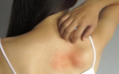 Por qué el estrés se refleja en nuestra piel