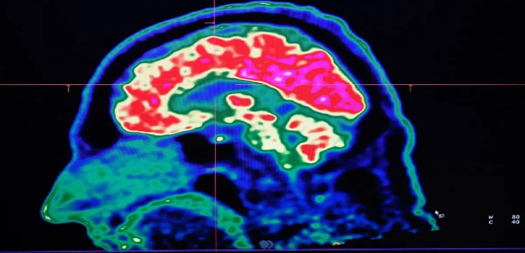 Científicos desarrollan una vacuna que mata y previene el cáncer de cerebro