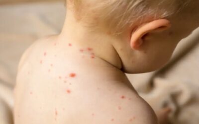 CDC alertan a viajeros internacionales sobre el sarampión: por qué