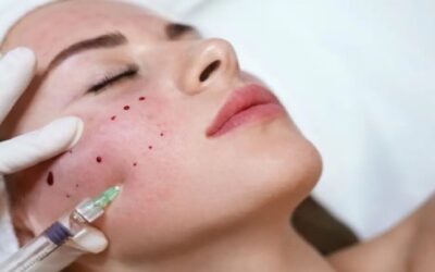 Descubren nuevos casos de VIH ligados a faciales de vampiro en Estados Unidos