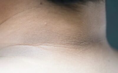 Manchas oscuras en el cuello: lo qué debes saber sobre la acantosis pigmentaria
