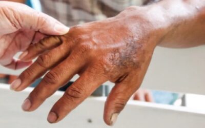 Aumentan casos de lepra en Florida: advierten los CDC