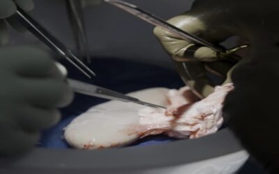 Trasplantan con éxito riñón de cerdo a hombre con muerte cerebral