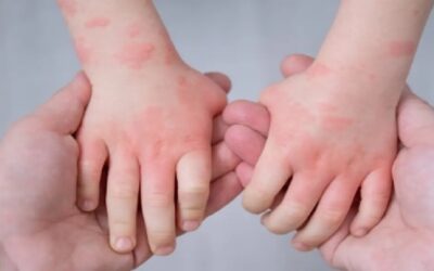 Los niños con eczema podrían necesitar más pruebas de alergia, según estudio