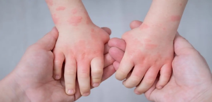 Los niños con eczema podrían necesitar más pruebas de alergia, según estudio