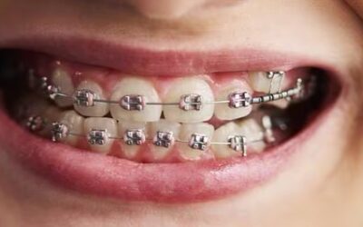 Brackets: ¿Cuáles son las consecuencias de una mala higiene durante una ortodoncia?