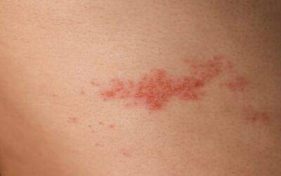 La vacuna contra el herpes zóster puede reducir también el riesgo de demencia