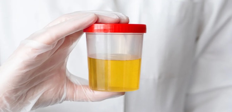 Una prueba de orina podría ayudar a detectar el cáncer de próstata
