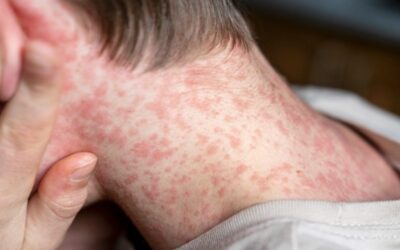 Estados Unidos registra récord de contagios de sarampión en 33 años