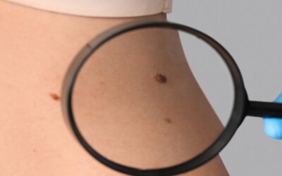 Nueva prueba casera puede identificar el melanoma, el cáncer de piel más agresivo