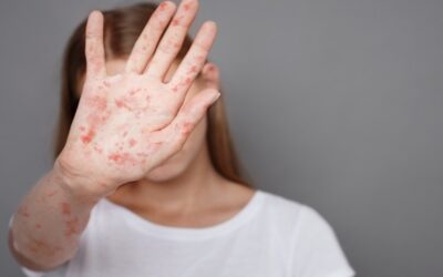 Repunte alarmante en casos de sarampión en EE.UU. y Canadá: advertencia sobre sus síntomas