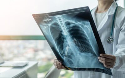 Pendiente de la bronquitis aguda, puede ir a más: causas, factores de riesgo y tratamiento