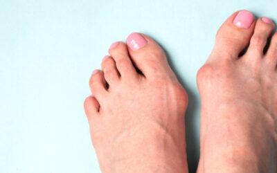 ¿Por qué aparecen los juanetes? Si ya los tienes, no sucumbas; si no, puedes prevenirlos