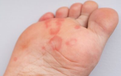 Manchas rojas en los pies: por qué aparecen y cómo tratarlas