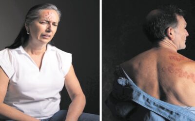 Seis mitos y verdades sobre el herpes zóster