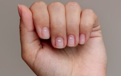 Leuconiquia, o cuando las manchas blancas aparecen en tus uñas, la causa.
