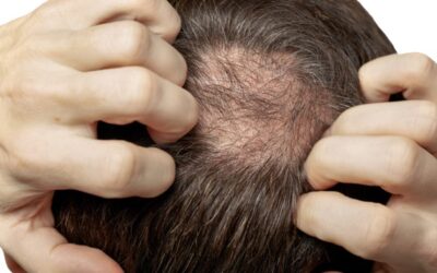 ¿Puedo evitar efectivamente la caída del cabello? Avances terapéuticos contra la alopecia en hombres y mujeres