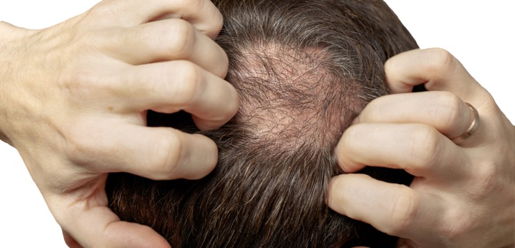 ¿Puedo evitar efectivamente la caída del cabello? Avances terapéuticos contra la alopecia en hombres y mujeres