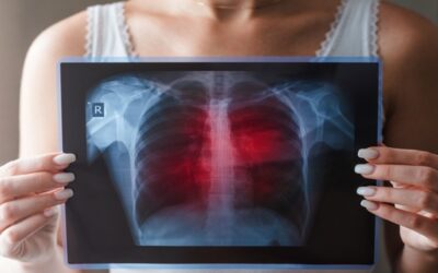 Cáncer de pulmón, un problema ignorado: mayoría de quienes deben someterse a pruebas de detección no lo hacen