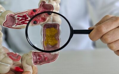 Impacto de la enfermedad inflamatoria intestinal: la importancia de la detección precoz