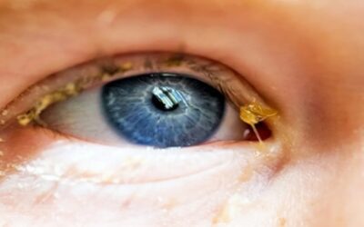 ¿Qué son las legañas y cuándo pueden indicar un problema de salud ocular?