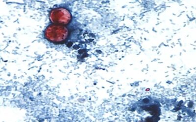 Casos de cyclospora en EEUU alcanzan cifras récord; Michigan apunta a la lechuga como posible causa.
