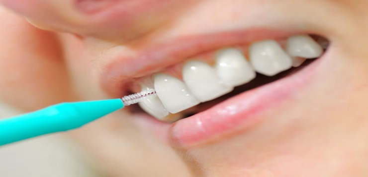 Los espacios entre los dientes también necesitan limpieza: cómo usar correctamente el cepillo interproximal