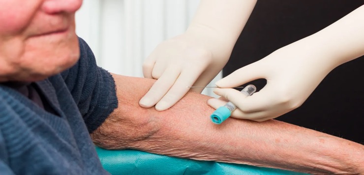 Nuevo análisis de sangre podría predecir el riesgo de Alzheimer hasta 10 años antes de los síntomas, según estudio